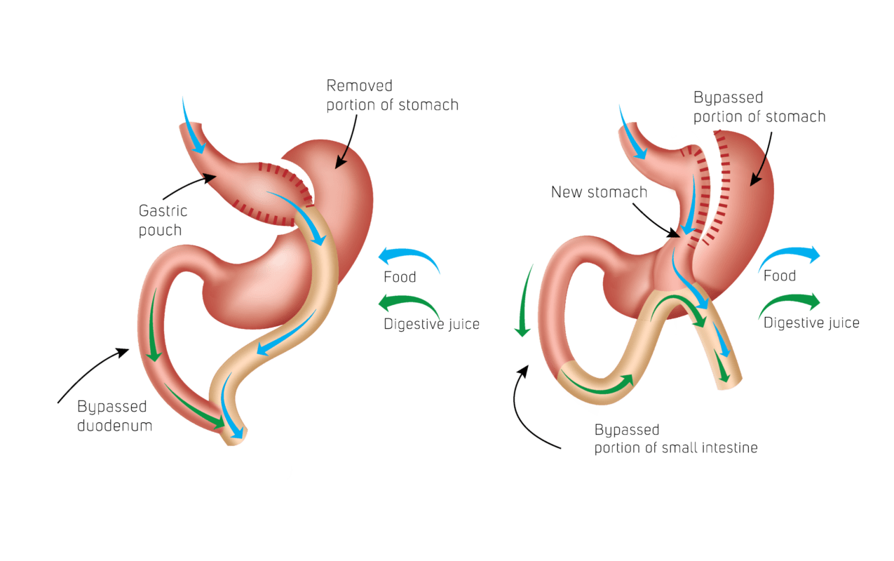 Gastric-Bypass-vs-Mini-Gastric-Bypass
