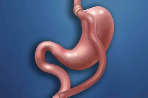 Gastric bypass leakage