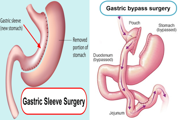 gastric-sleeve-vs-gastric-bypass