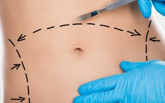  If you're contemplating liposuction, it's crucial to understand who is a suitable candidate for liposuction surgery.