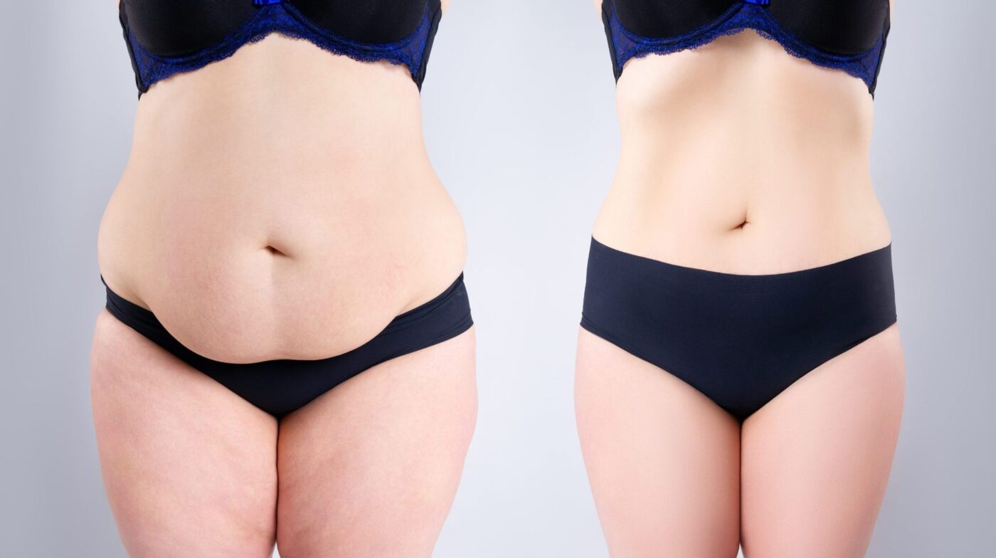 abdominoplasty surgery turkey