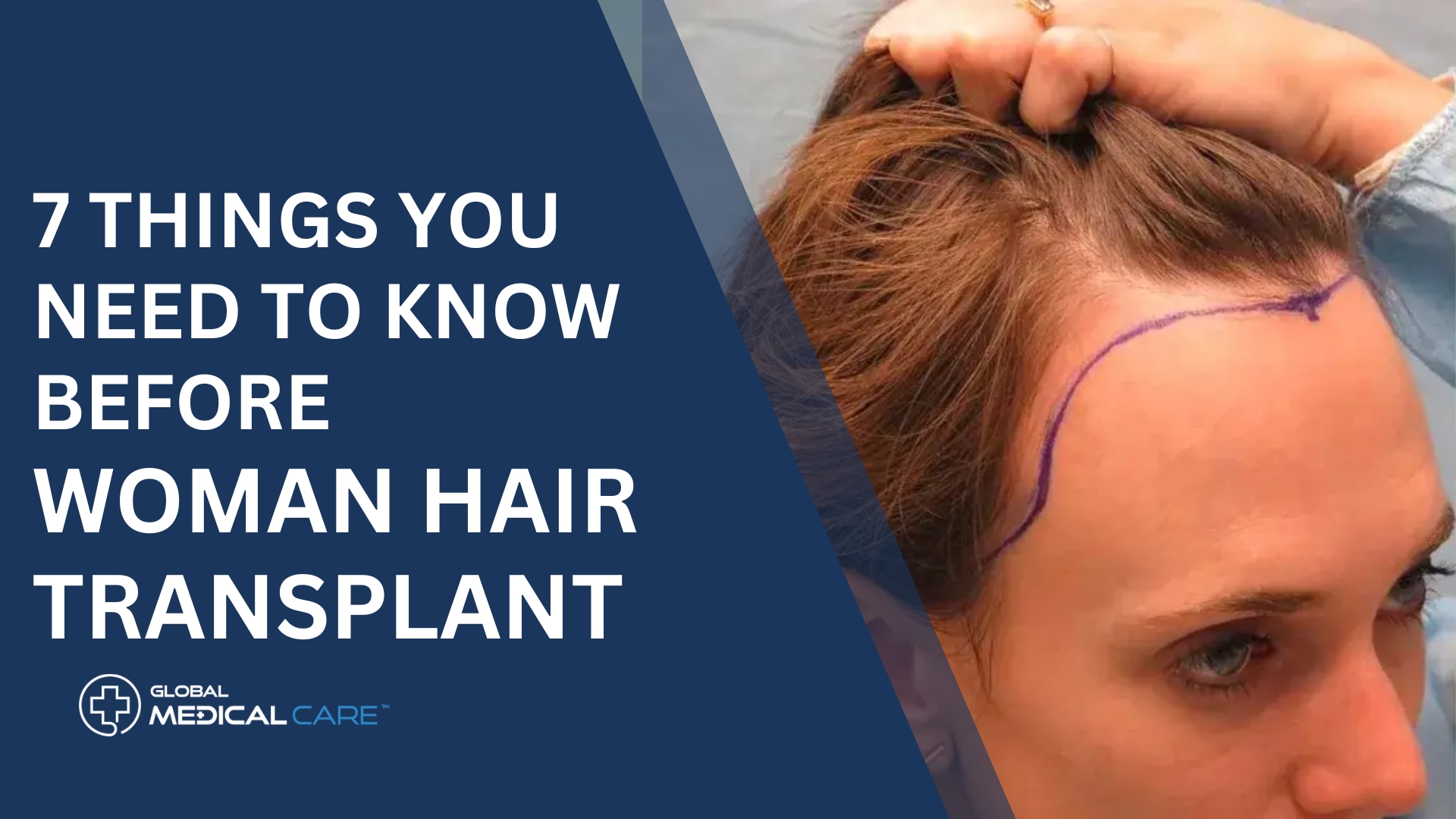 Things You Need To Know Before woman hair transplant