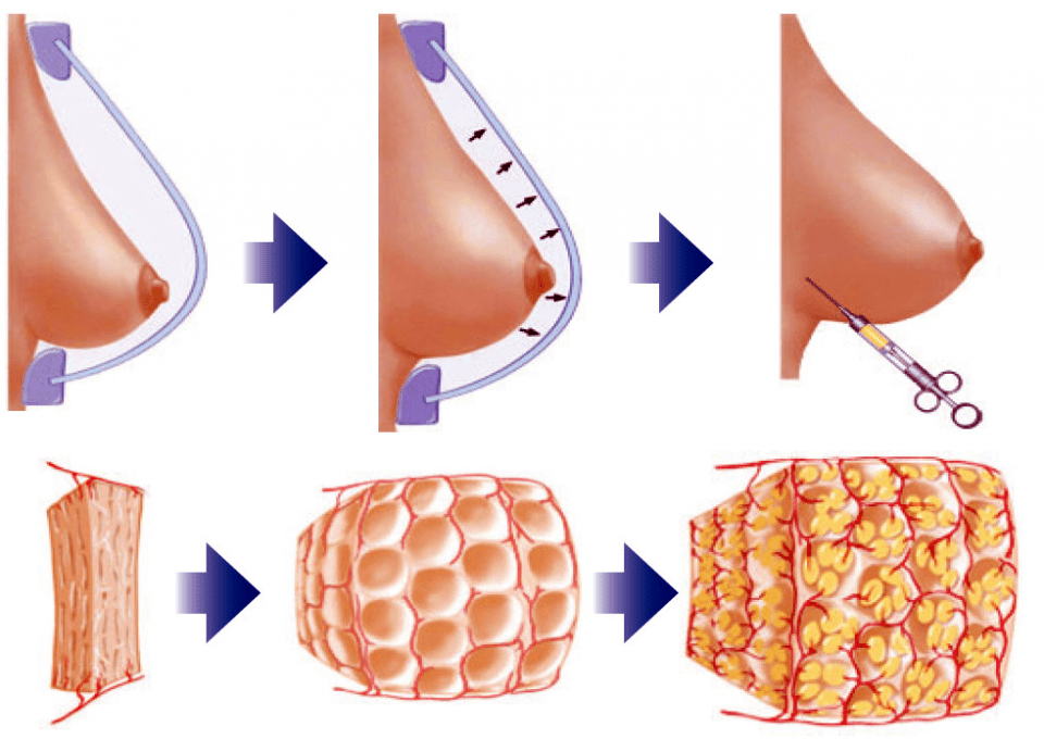 mummy makeover fat transfer turkey