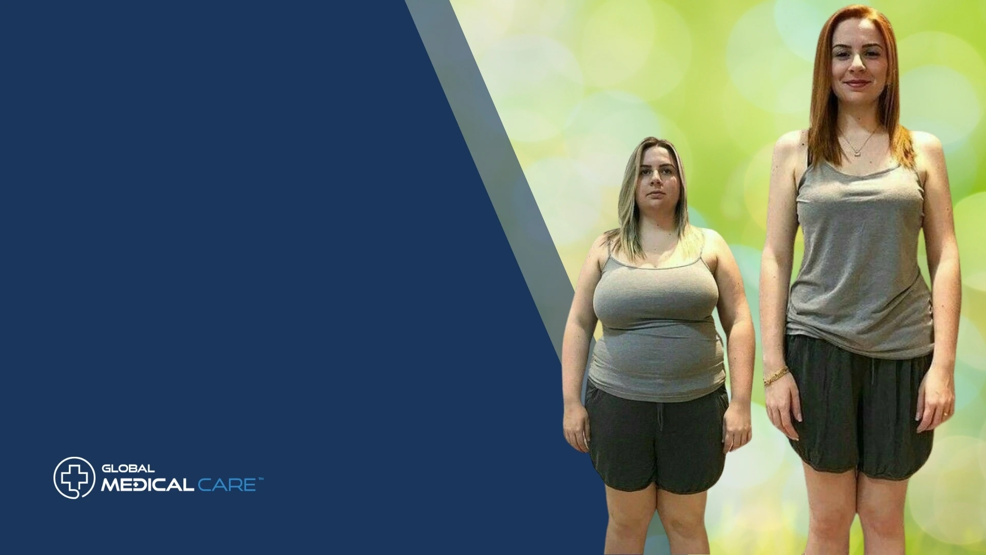 obesity surgery turkey