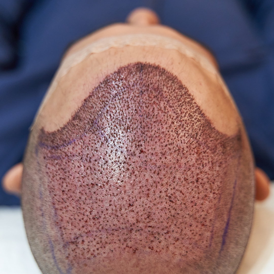 How Long Does Transplanted Hair Last?