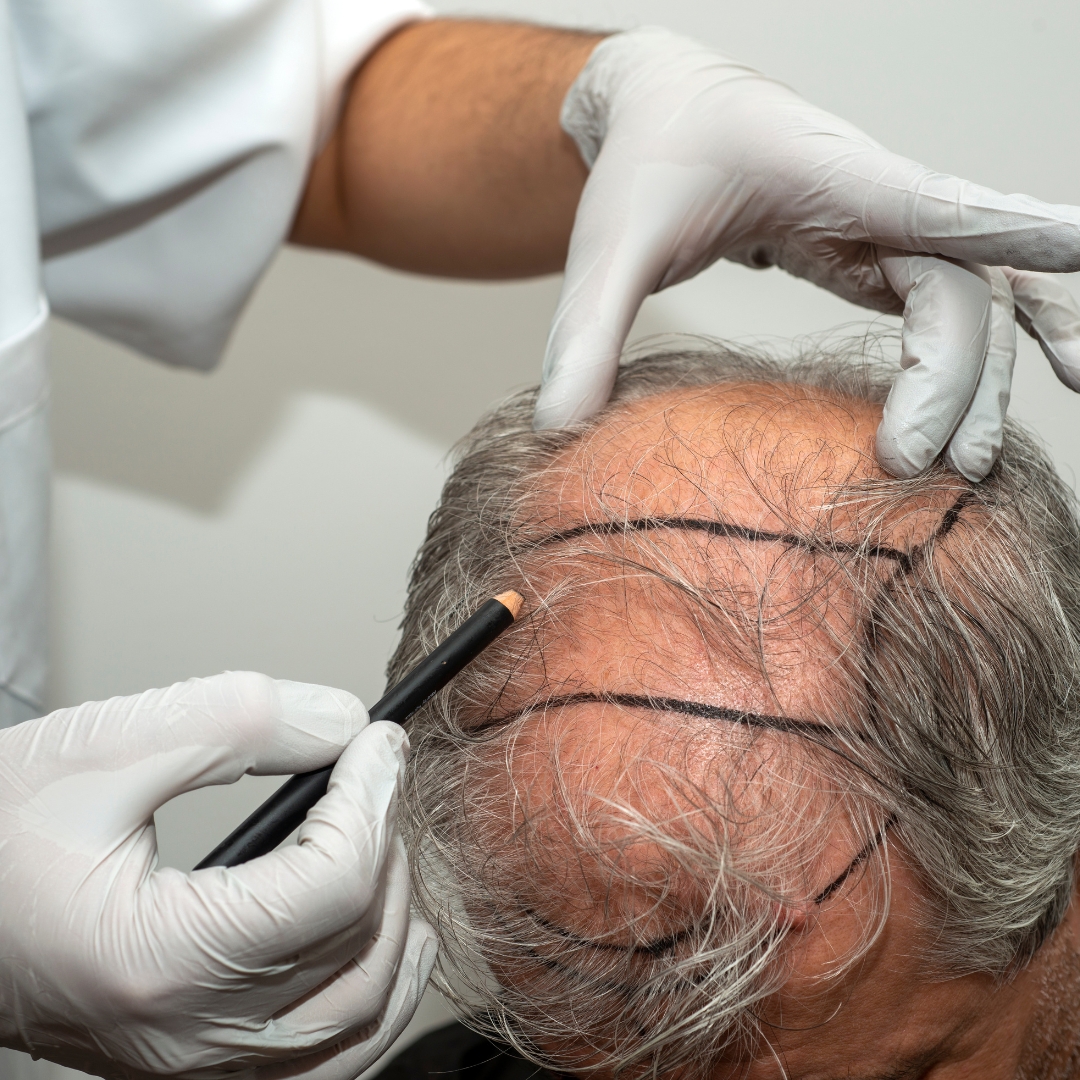 hair transplant surgery results