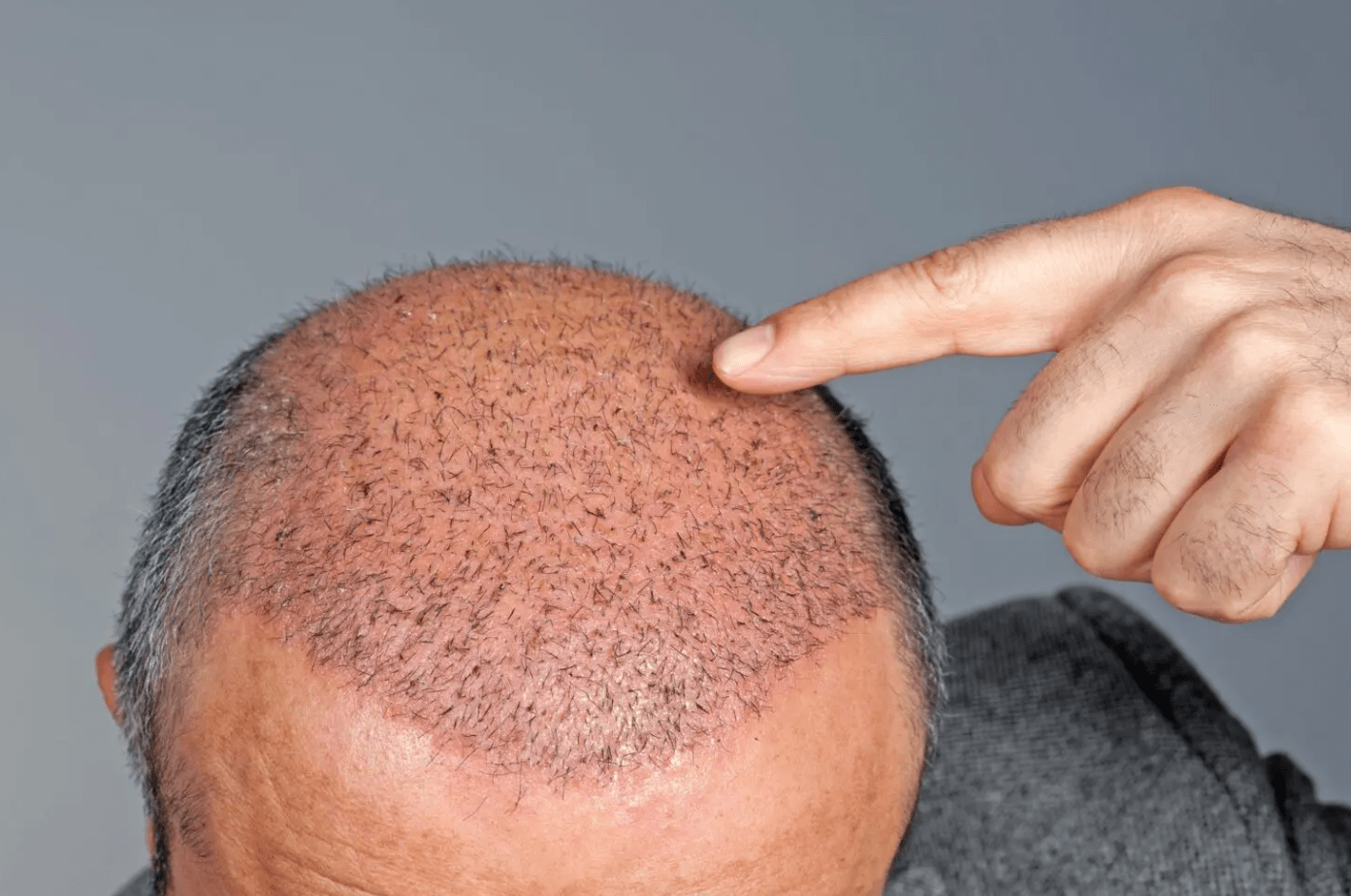 18 worst mistakes to avoid after a hair transplant