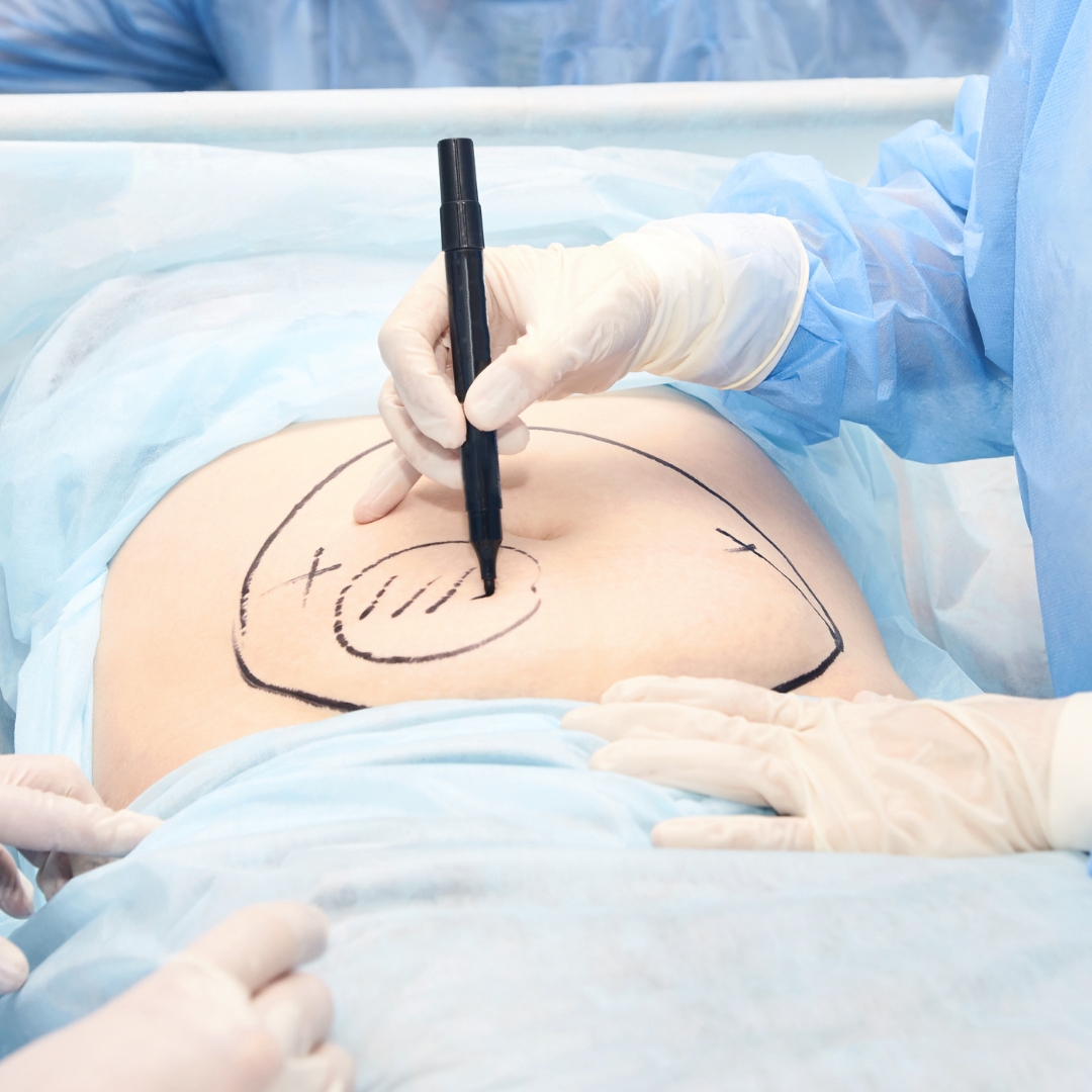 liposuction visit degated NUST met the Dir Res now