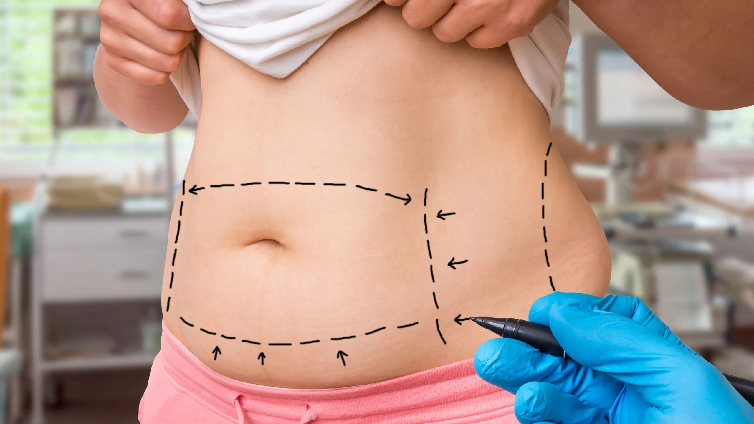 Tummy Tuck Abdominoplasty vs Liposuction