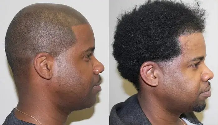 Afro Hair Transplant Cost