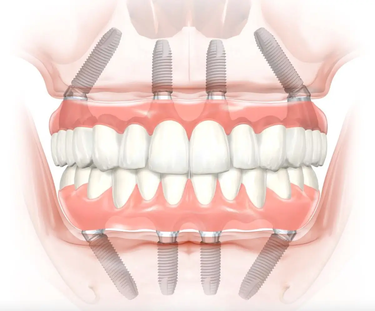 All On 4 dental implants