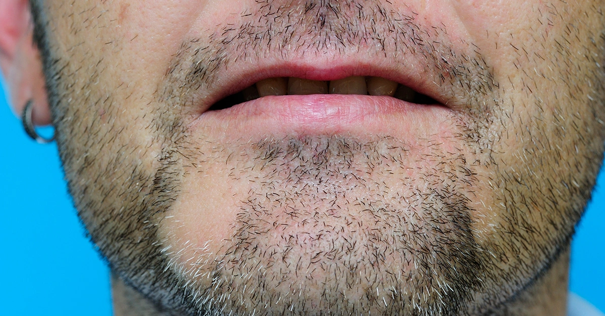 Alopecia Barbae for Beard Transplantation
