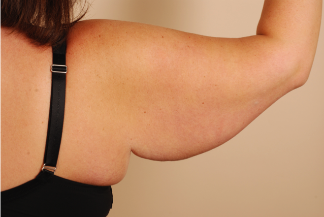 post bariatric arm lift surgery turkey