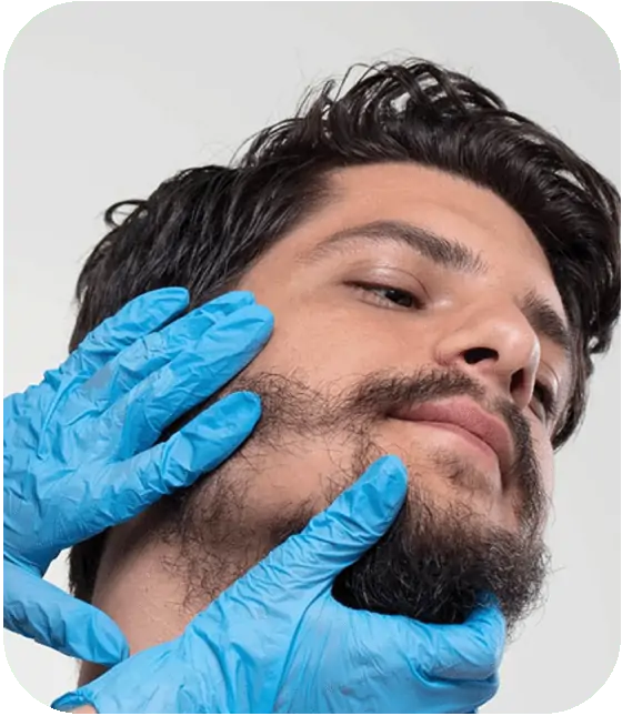 beard-transplant