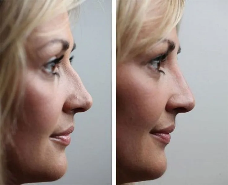 How long does a nose job take?