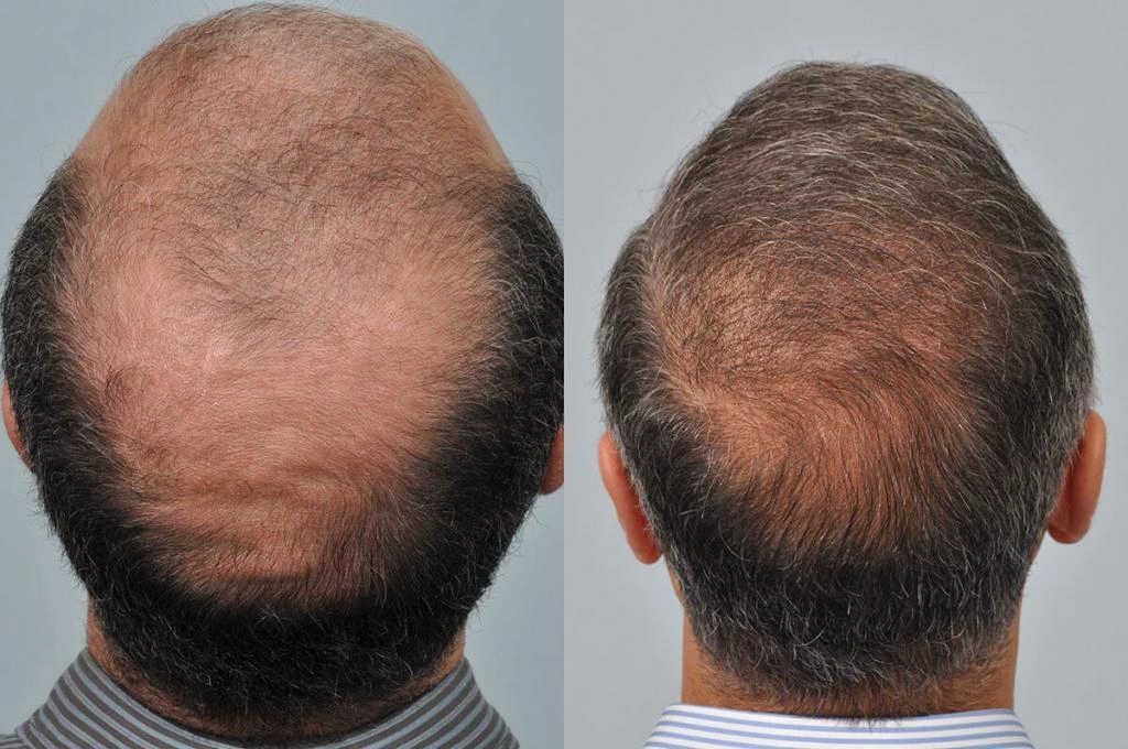 Crown Hair Transplants