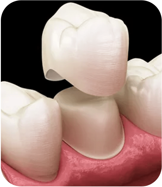 dental crown treatment turkey