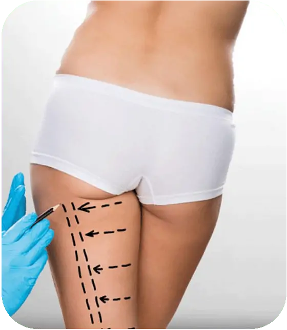thigh lift surgery turkey
