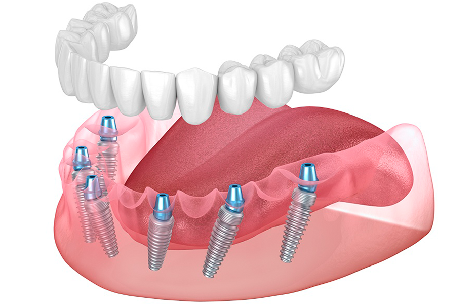 All On 6 Dental Implants