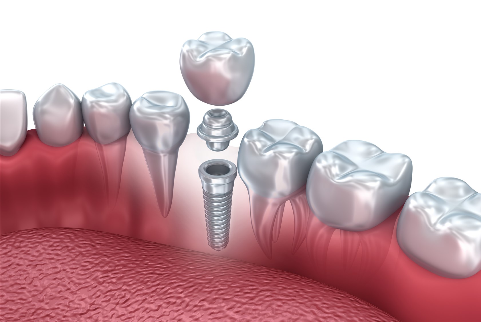 Dental Bridges