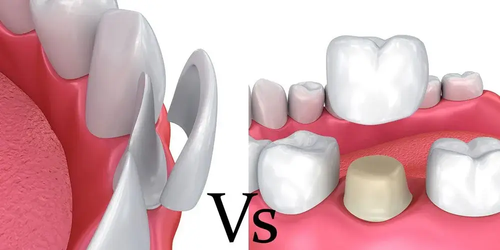 Dental crowns and veneers