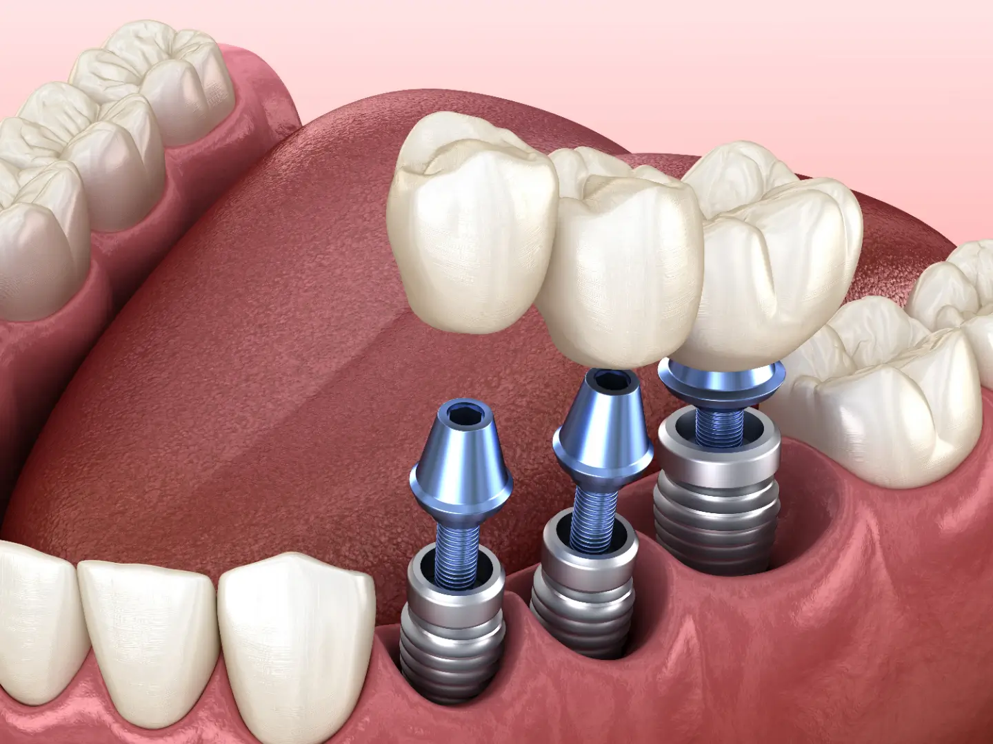 Permanent dental implants