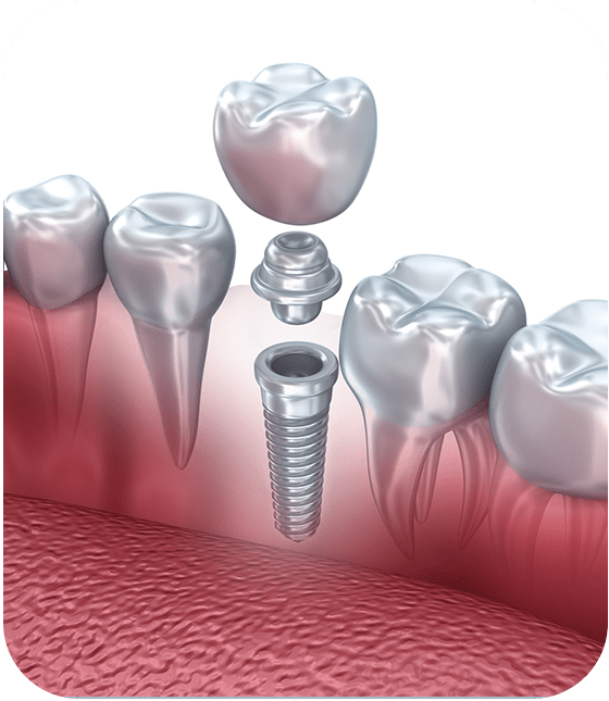 dental implant treatment turkey