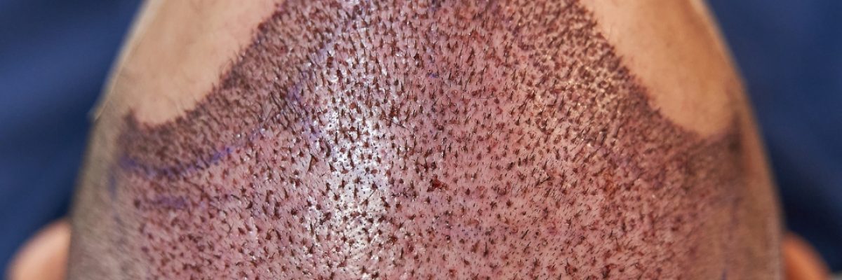How Long Does Transplanted Hair Last?