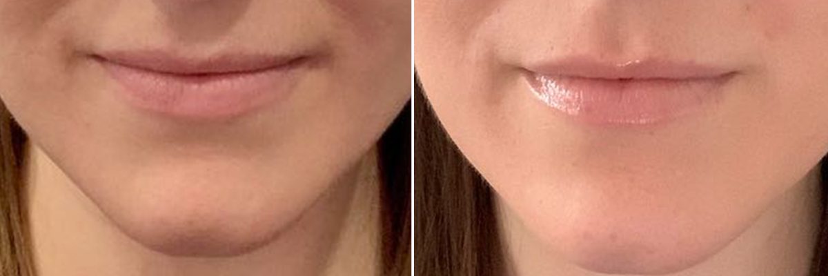 The nasolabial folds, also known as the smile line or laugh line, is a prominent facial feature that can impact your appearance.