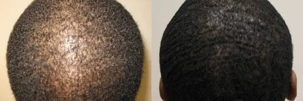 What is the recovery time for an afro hair transplant?