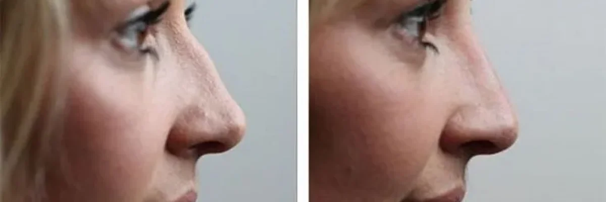 How long does a nose job take?