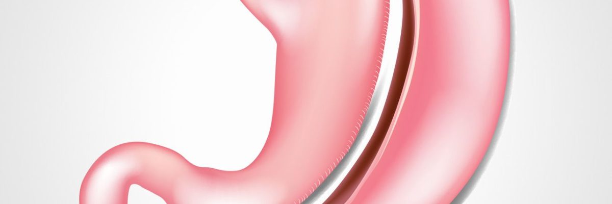 Hardest part of a Gastric Sleeve