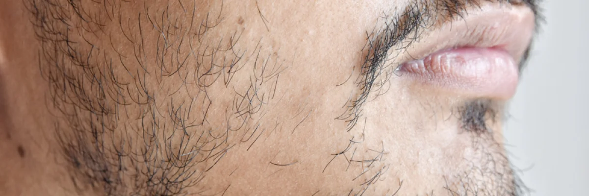 Patchy Beard Growth: How to Handle it?