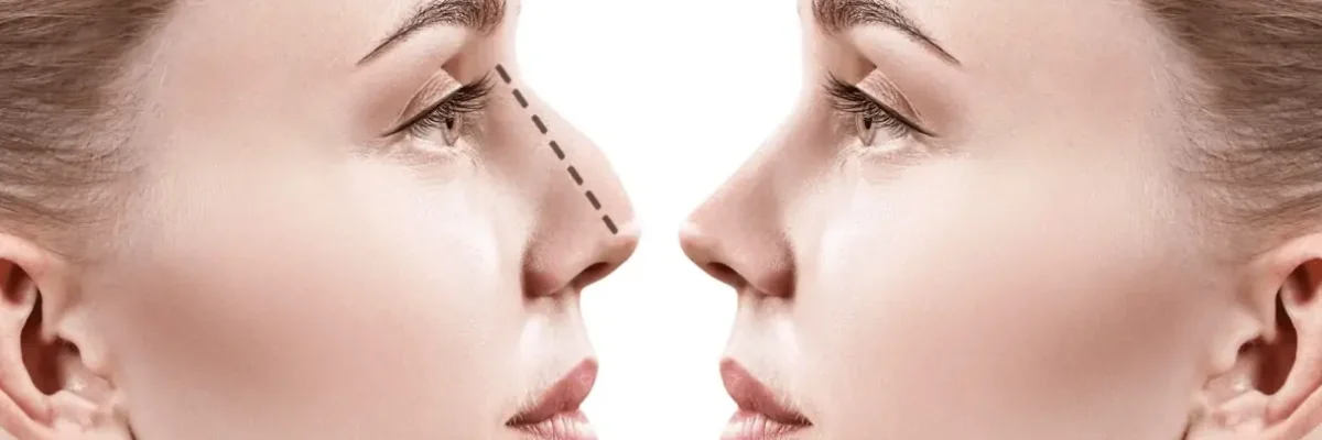types of rhinoplasty