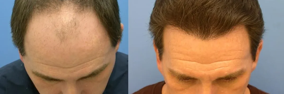Why Do Hair Transplants Fail?