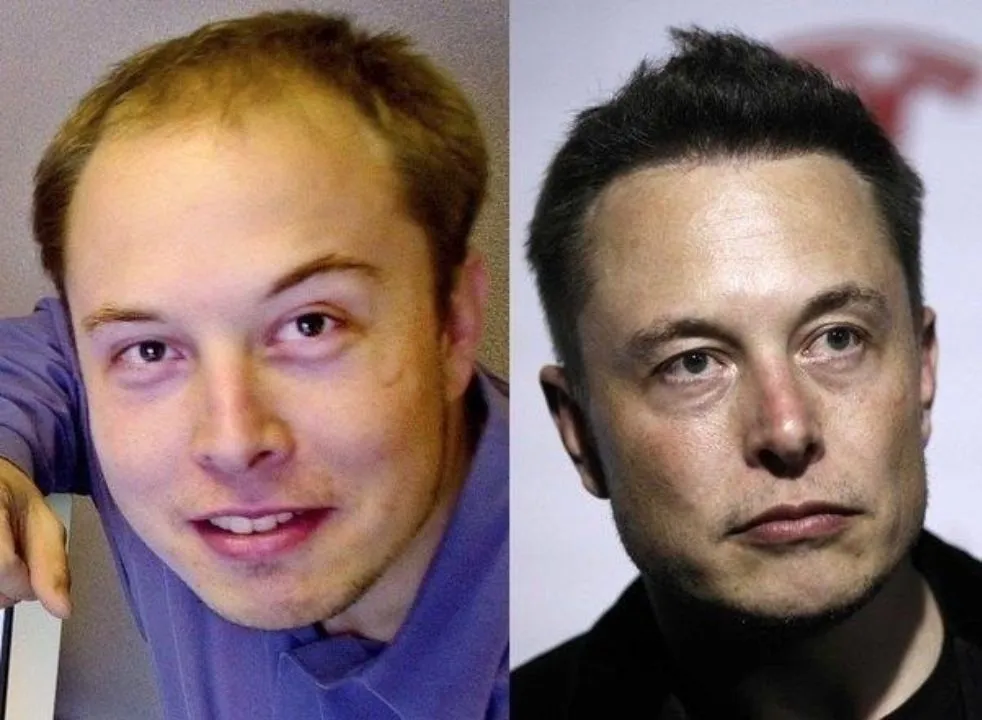 Elon Musk Hair Transplantation | Global Medical Care