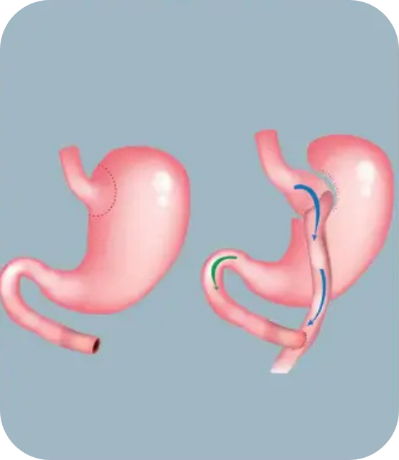 gastric bypass surgery turkey