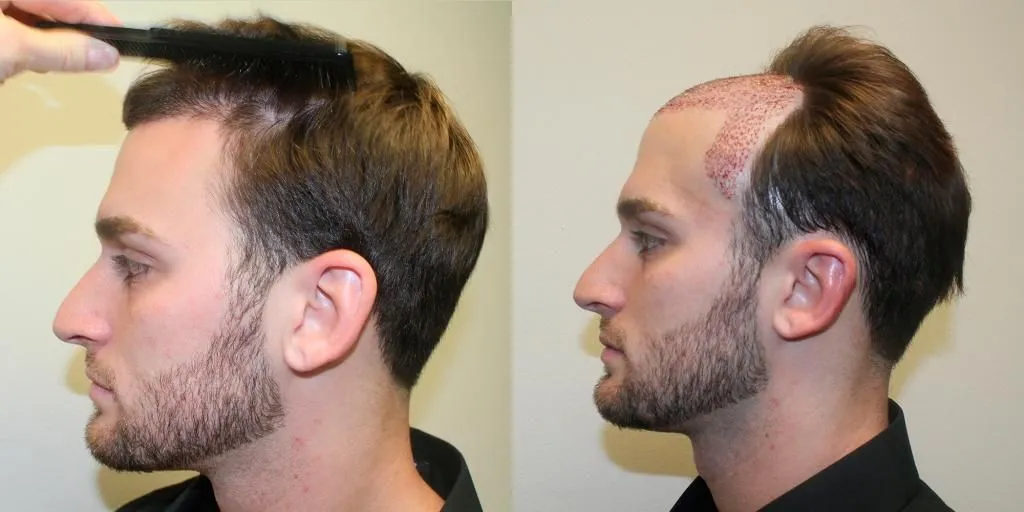 Hair Graft Before and After