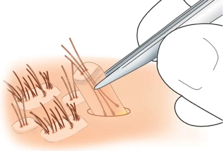 Best Hair Grafting Technique For Afro
