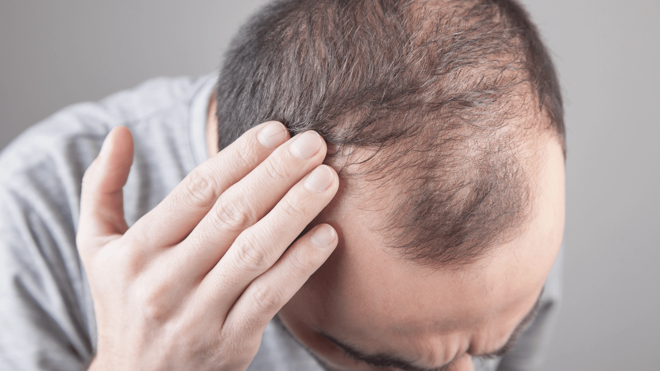 Hair Transplant for Thinning