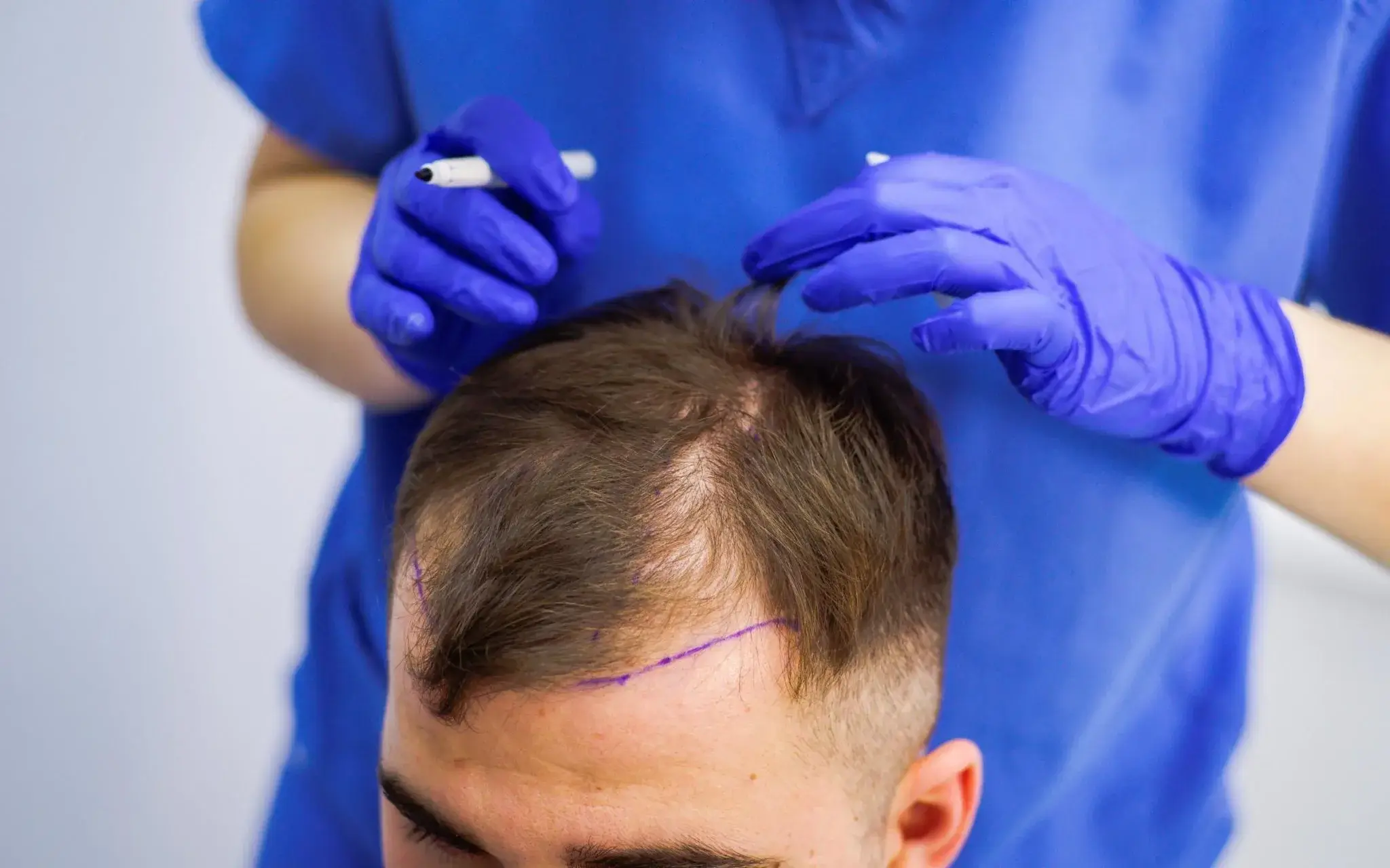 hair-transplant-pay