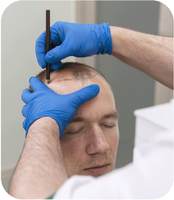 hair transplant in turkey