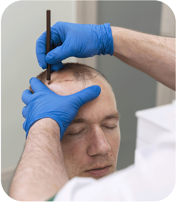 hair transplant in turkey
