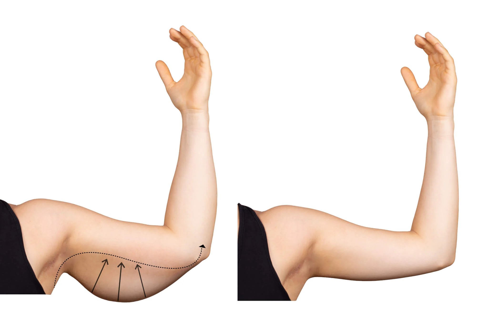 How painful is an arm lift
