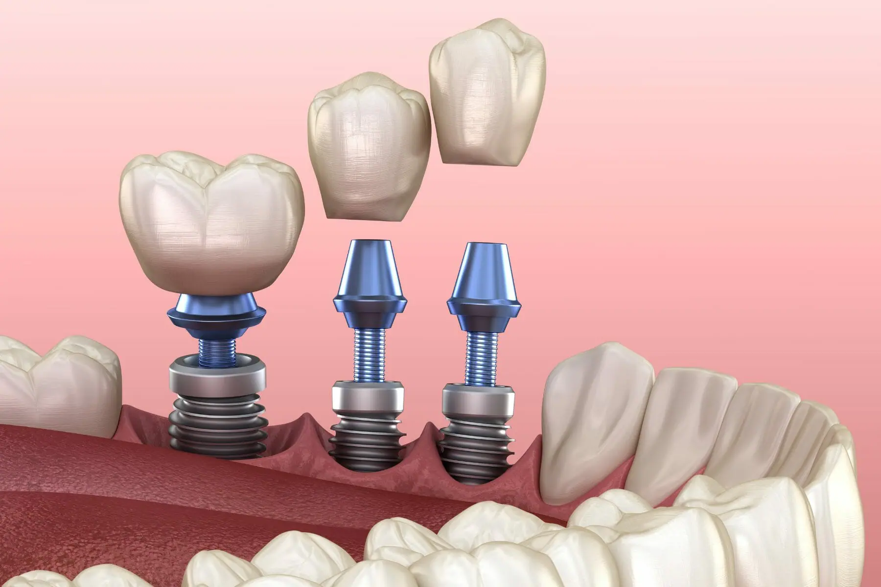 Permanent implants