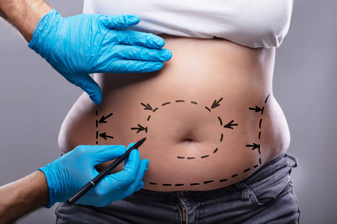 liposuction surgery turkey