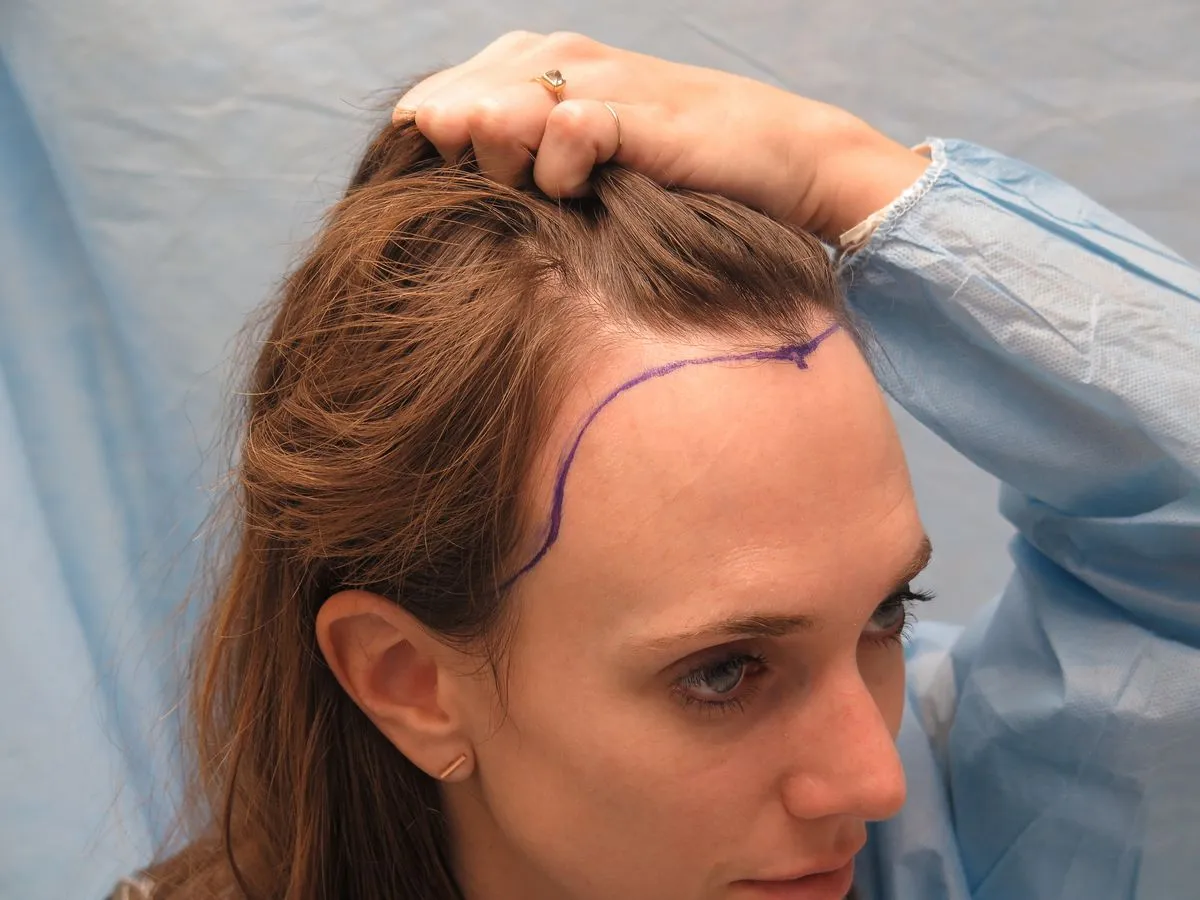 Ludwig Scale: A Means to Classify Female Pattern Baldness | Global ...