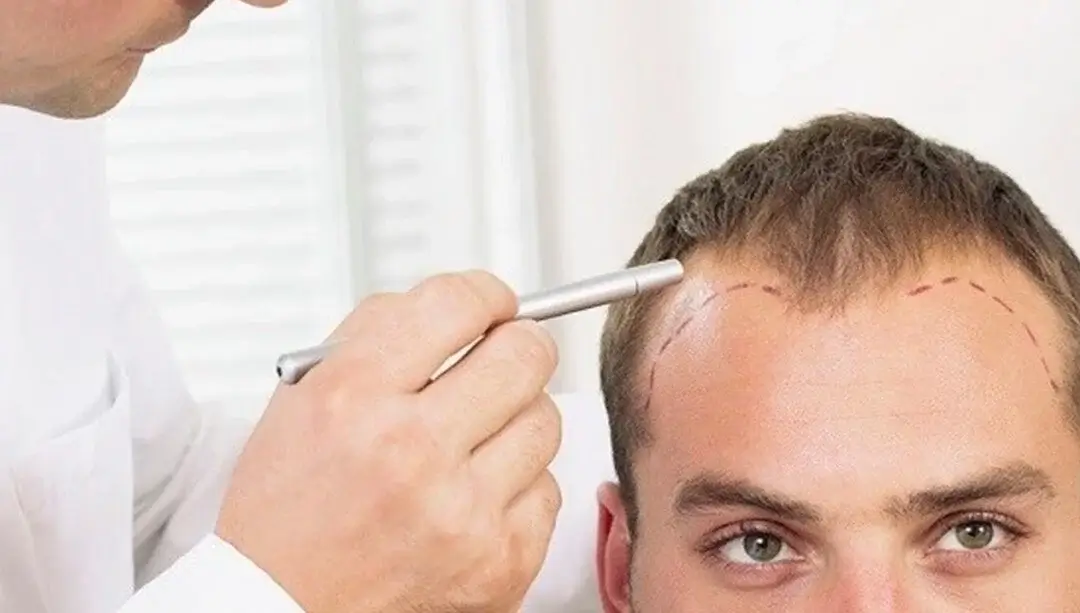 micro-hair-transplant