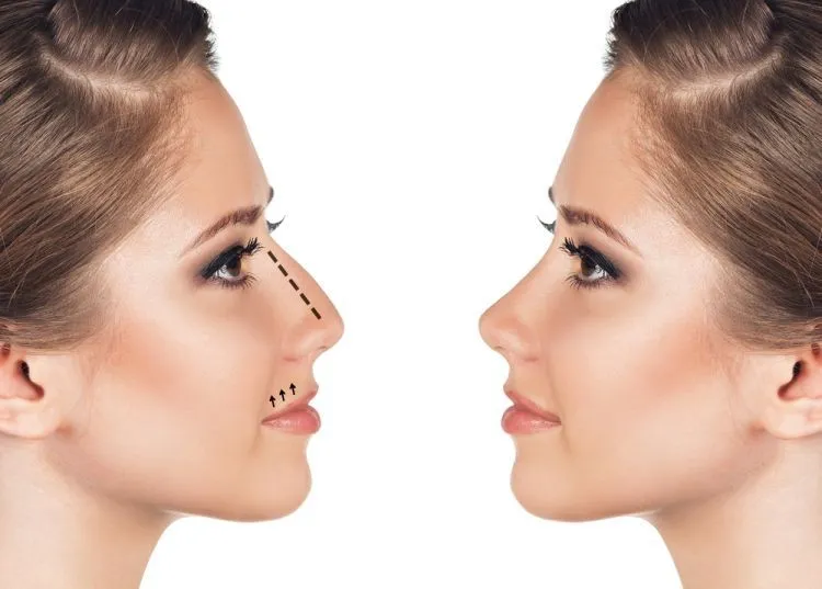 nose jobs