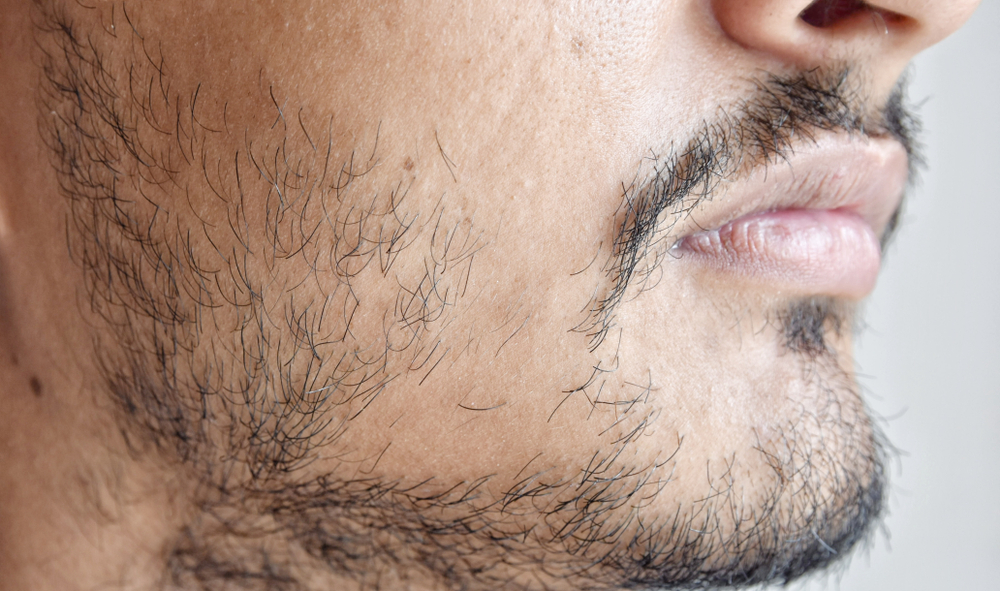 Patchy Beard Growth: How to Handle it?